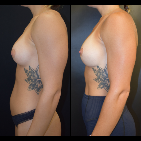 capsular-contracture-breast-implant-revision-plastic-surgery-nyc-before-after-le-patient-1-5