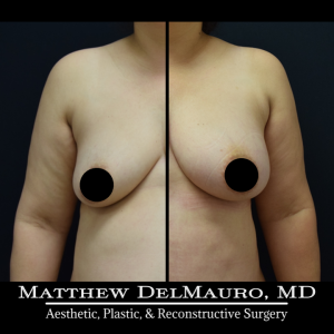 Before-After-3.5-Months-–-Lipoabdominoplasty-Fat-Grafting-to-Bilateral-Breasts1