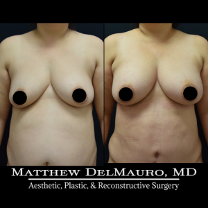 Before-After-3.5-Months-–-Lipoabdominoplasty-Fat-Grafting-to-Bilateral-Breasts2