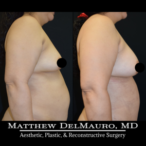 Before-After-3.5-Months-–-Lipoabdominoplasty-Fat-Grafting-to-Bilateral-Breasts3