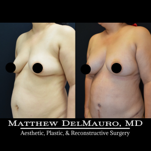 Before-After-3.5-Months-–-Lipoabdominoplasty-Fat-Grafting-to-Bilateral-Breasts4