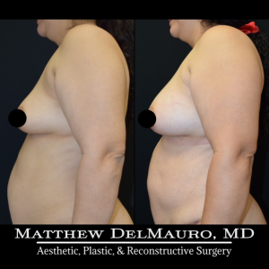 Before-After-3.5-Months-–-Lipoabdominoplasty-Fat-Grafting-to-Bilateral-Breasts5