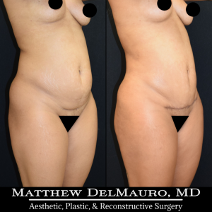 Before-After-3.75-Months-–-Liposuction-of-Abdomen-Waist-Flanks-Abdominal-Scar-Revision-Fat-Grafting-to-Bilateral-Hips3