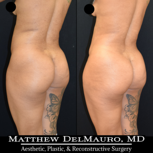 Before-After-3.75-Months-–-Liposuction-of-Abdomen-Waist-Flanks-Abdominal-Scar-Revision-Fat-Grafting-to-Bilateral-Hips7