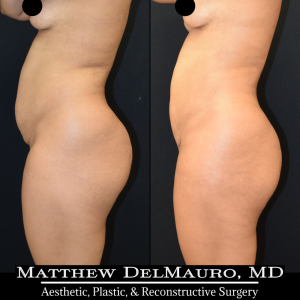 Before-After-3.75-Months-–-Liposuction-of-Abdomen-Waist-Flanks-Abdominal-Scar-Revision-Fat-Grafting-to-Bilateral-Hips8