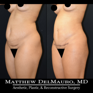 Before-After-3.75-Months-–-Liposuction-of-Abdomen-Waist-Flanks-Abdominal-Scar-Revision-Fat-Grafting-to-Bilateral-Hips9