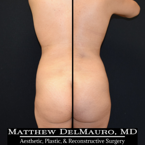 Before-After-1-Years-1-Months-–-Lipo360-2