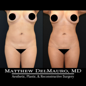 Before-After-1-Years-1-Months-–-Lipo360-3