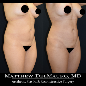 Before-After-1-Years-1-Months-–-Lipo360-4