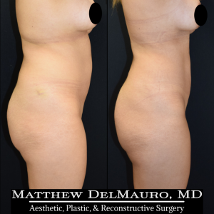 Before-After-1-Years-1-Months-–-Lipo360-5