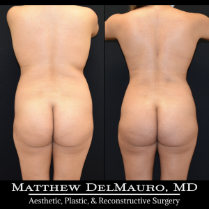 Before-After-1-Years-1-Months-–-Lipo360-6