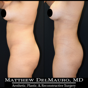 Before-After-1-Years-1-Months-–-Lipo360-7