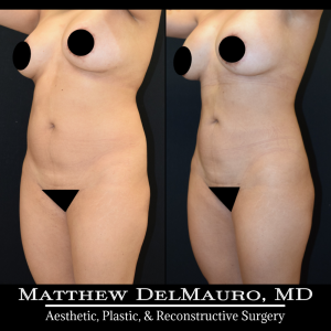 Before-After-1-Years-1-Months-–-Lipo360-8