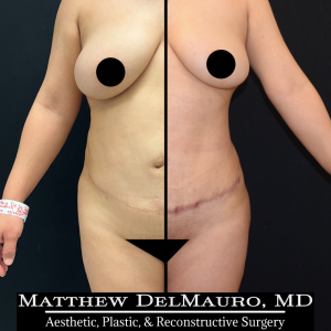 Before-After-3-Months-–-Tummy-Tuck-Tune-Up-Lipo360-1