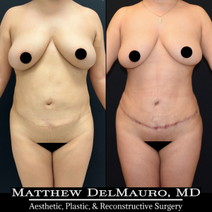 Before-After-3-Months-–-Tummy-Tuck-Tune-Up-Lipo360-2