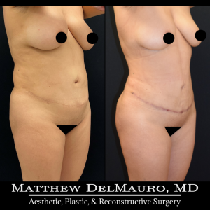 Before-After-3-Months-–-Tummy-Tuck-Tune-Up-Lipo360-3