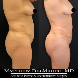 Before-After-3-Months-–-Tummy-Tuck-Tune-Up-Lipo360-4