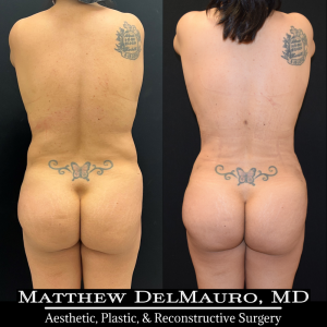 Before-After-3-Months-–-Tummy-Tuck-Tune-Up-Lipo360-5