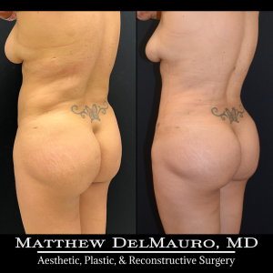 Before-After-3-Months-–-Tummy-Tuck-Tune-Up-Lipo360-6