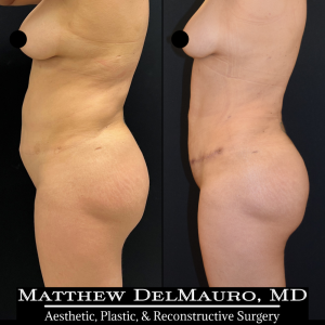 Before-After-3-Months-–-Tummy-Tuck-Tune-Up-Lipo360-7