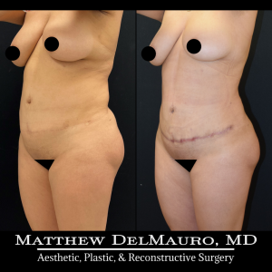 Before-After-3-Months-–-Tummy-Tuck-Tune-Up-Lipo360-8