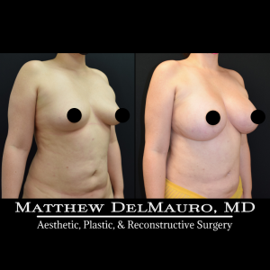 Before-After-4-Months-Lipo360-Liposuction-of-Bilateral-Upper-Arms-Fat-Grafting-To-Bilateral-Breasts-and-Lower-Abdomen-Bilateral-Breast-Augmentation-Silicone1
