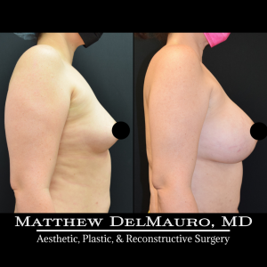 Before-After-4-Months-Lipo360-Liposuction-of-Bilateral-Upper-Arms-Fat-Grafting-To-Bilateral-Breasts-and-Lower-Abdomen-Bilateral-Breast-Augmentation-Silicone2