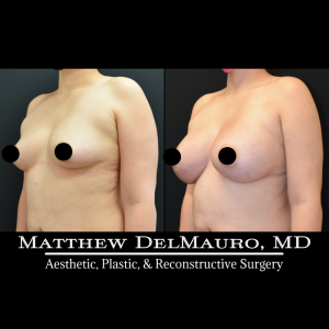 Before-After-4-Months-Lipo360-Liposuction-of-Bilateral-Upper-Arms-Fat-Grafting-To-Bilateral-Breasts-and-Lower-Abdomen-Bilateral-Breast-Augmentation-Silicone3