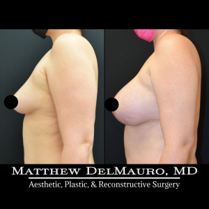 Before-After-4-Months-Lipo360-Liposuction-of-Bilateral-Upper-Arms-Fat-Grafting-To-Bilateral-Breasts-and-Lower-Abdomen-Bilateral-Breast-Augmentation-Silicone4