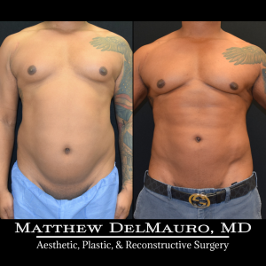 Before-After-6.5-Months-–-Lipo360-Liposuction-of-Chest-Fat-Grafting-to-Chest3