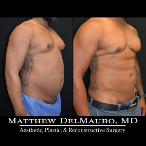 Before-After-6.5-Months-–-Lipo360-Liposuction-of-Chest-Fat-Grafting-to-Chest4