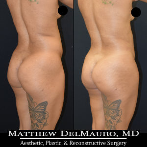 Before-After-3.75-Months-–-Liposuction-of-Abdomen-Waist-Flanks-Abdominal-Scar-Revision-Fat-Grafting-to-Bilateral-Hips5
