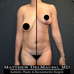 Before-After-4-Months-–-Breast-Lift-Liposuction-of-Abdomen1
