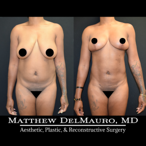 Before-After-4-Months-–-Breast-Lift-Liposuction-of-Abdomen3