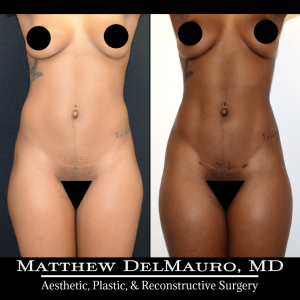 Before-After-6.5-Months-–-Abdominal-Liposuction2
