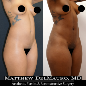 Before-After-6.5-Months-–-Abdominal-Liposuction3