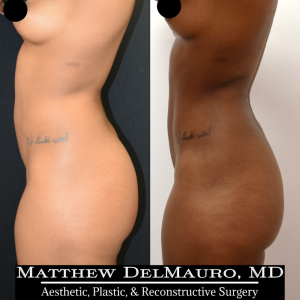 Before-After-6.5-Months-–-Abdominal-Liposuction5