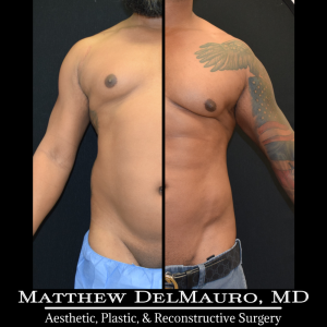 Before-After-6.5-Months-–-Lipo360-Liposuction-of-Chest-Fat-Grafting-to-Chest1