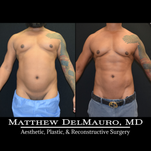 Before-After-6.5-Months-–-Lipo360-Liposuction-of-Chest-Fat-Grafting-to-Chest2