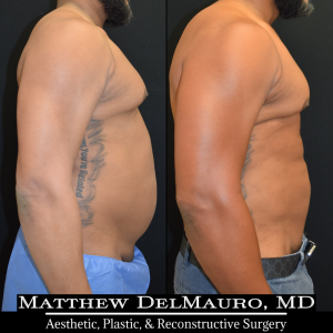 Before-After-6.5-Months-–-Lipo360-Liposuction-of-Chest-Fat-Grafting-to-Chest5