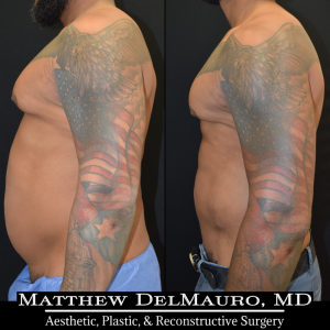 Before-After-6.5-Months-–-Lipo360-Liposuction-of-Chest-Fat-Grafting-to-Chest6