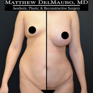 Before-After-3-Months-–-Breast-Augmentation-Silicone-Lipo-Abdominoplasty1