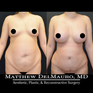 Before-After-3-Months-–-Breast-Augmentation-Silicone-Lipo-Abdominoplasty3