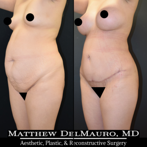 Before-After-3-Months-–-Breast-Augmentation-Silicone-Lipo-Abdominoplasty4
