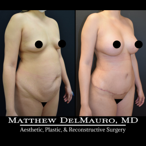 Before-After-3-Months-–-Breast-Augmentation-Silicone-Lipo-Abdominoplasty5