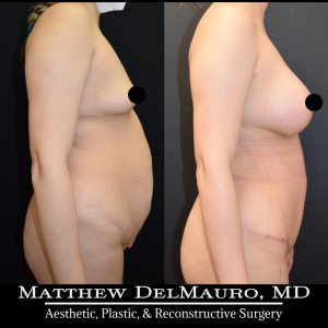 Before-After-3-Months-–-Breast-Augmentation-Silicone-Lipo-Abdominoplasty6