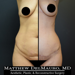 Before-After-4-Months-–-Lipo-Abdominoplasty1