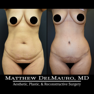 Before-After-4-Months-–-Lipo-Abdominoplasty2