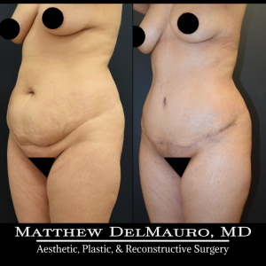 Before-After-4-Months-–-Lipo-Abdominoplasty3
