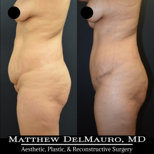 Before-After-4-Months-–-Lipo-Abdominoplasty4